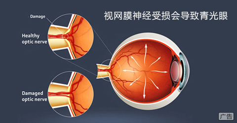 视网膜神经受损会导致青光眼吗？